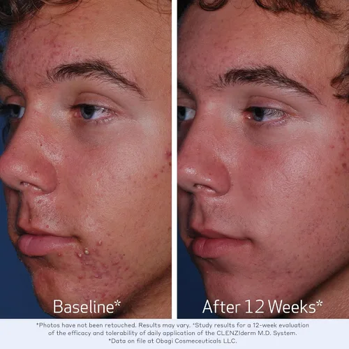 Vista 4 de Obagi CLENZIderm M.D. Tónico exfoliante BHA para terapia de poros, desobstruye los poros con tratamiento del acné con ácido salicílico al 2%, 5 onzas