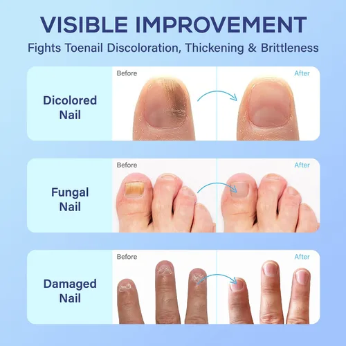Vista 3 de PHARMBANNER Tratamiento de hongos en las uñas de los pies extra fuerza: 25% de ácido undecilénico renovación de hongos en las uñas y uñas - Kit