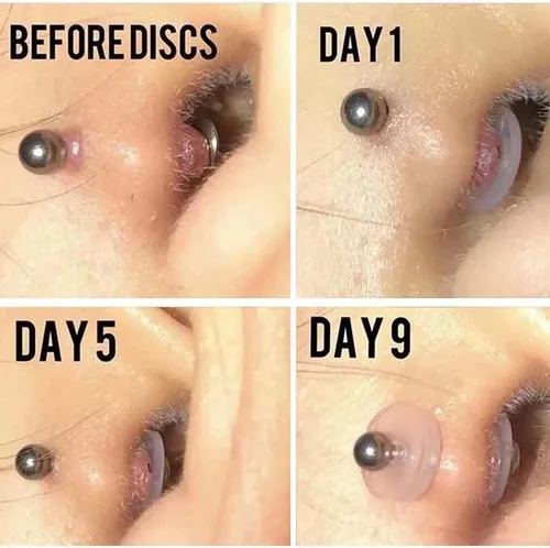 Vista 7 de Bloomfall Disco de perforación transparente para tratamiento de perforación de nariz, aretes de silicona para almohadillas curativas de queloides