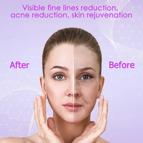 Vista 4 de YourMate Dispositivo de fototerapia Máquina de varita facial de alta frecuencia con tubos de argón para cara, barbilla, cuello, máquina facial con 4