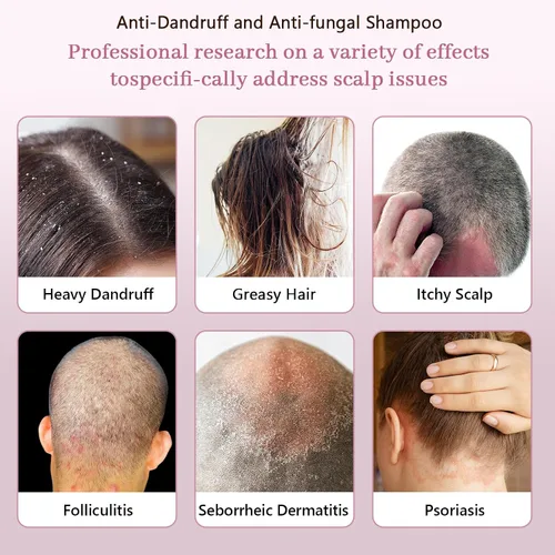 Vista 6 de Champú antifúngico para dermatitis seborreica, foliculitis y psoriasis, champú para la caspa para hombres y mujeres, alivio para el cuero cabelludo