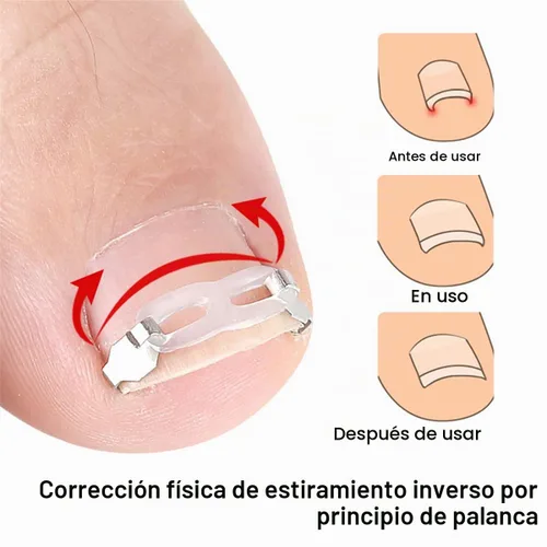 Vista 2 de Juego de herramientas de corrección de uñas encarnadas, 2 clips de inserción de acero inoxidable para tratamiento de uñas encarnadas, tiras