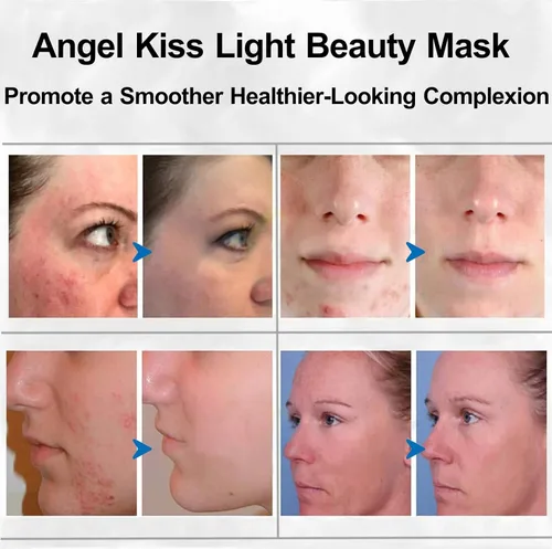 Vista 3 de Tratamiento facial Angel Kiss luz verde, azul, roja, terapia con fotónes, LED, tratamiento facial de belleza, cuidado de la piel fototerapia