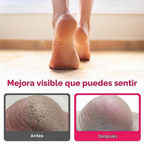 Vista 6 de FOOTLOGIX Fórmula para piel áspera con espiraleen, 4.23 oz