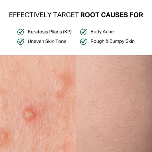 Vista 4 de Y'OUR Gel de baño antiacné de aloe vera Fórmula suave y no seca Suaviza la textura y unifica el tono Limpia el bacne y los brotes para mujeres