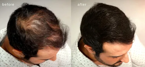Vista 3 de Fibras capilares voluminizadoras con queratina real para adelgazar el cabello/pérdida de cabello – Dermatológicamente probado y certificado