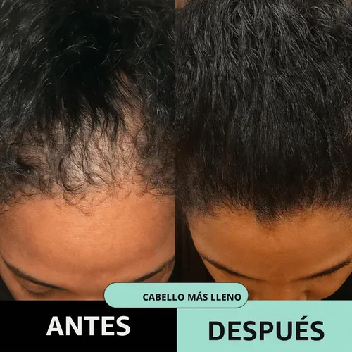 Vista 7 de Kit de renovación de cabello con micro infusión, suero para el cabello con ácido hialurónico, péptido y ampollas de suero botánico