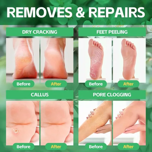 Vista 2 de Remojo de pies de pedicura, baño de pies de spa, kit de pedicura, baño de pies de burbujas para pies agrietados y cansados y secos, pies de atletas
