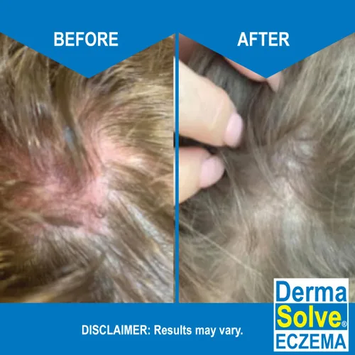 Vista 5 de Dermasolve Champú para aliviar el eccema – Terapia libre de cuero cabelludo y caspa que protege, hidrata y repara la piel para niños y adultos, sin