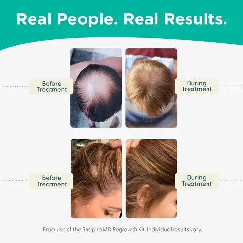 Vista 5 de Shapiro MD Hair Growth Experts Champú y Acondicionador contra la Caída del Cabello, Fórmula Vegana Anti-DHT para Cabello Fino Desarrollado por