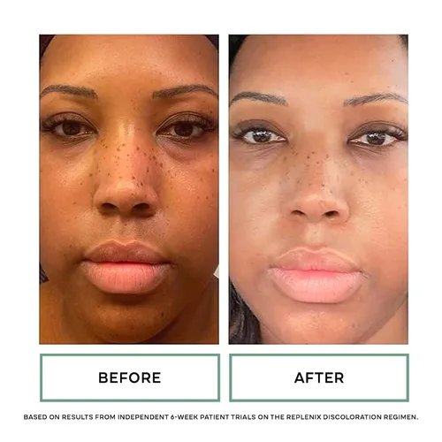 Vista 4 de Replenix Suero de colágeno con vitamina C Pro, tratamiento facial antienvejecimiento iluminador con antioxidantes de grado médico para decoloración
