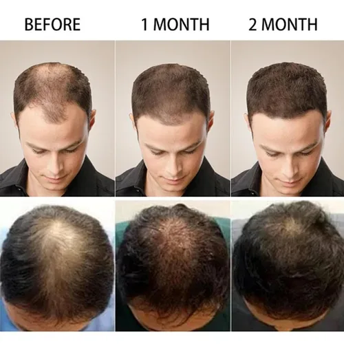 Vista 7 de 5% Minoxidil Hair Growth for Men and Women,Minoxidil Hair Growth Serum,Fast Regrowth & Strengthens Hair Roots,for Thinning Hair Loss to Grow Thicker