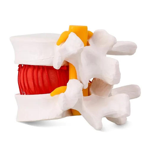 Vista 3 de Modelo de hernia de disco lumbar anatómica humana, modelo de hernia de disco lumbar de tamaño real - Modelo de columna lumbar para enseñar
