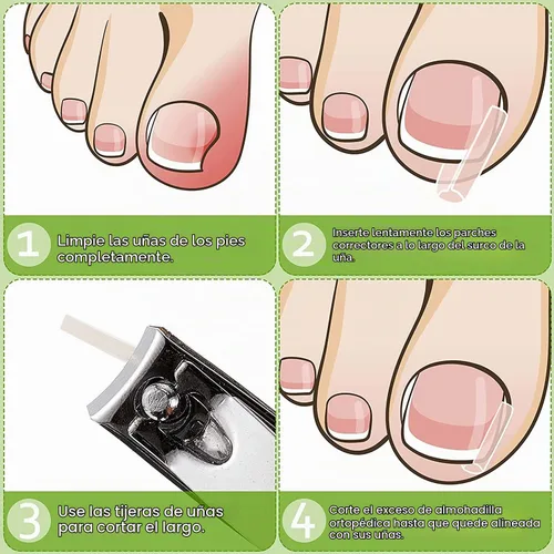 Vista 4 de Tiras correctoras de uñas encarnadas profesionales, 50 tiras correctoras de uñas encarnadas, tiras curvadas para enderezar las uñas del pie, clips