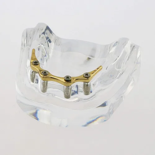 Vista 3 de Dental Dientes Modelo Oro Plata Demostración Color Practise Enseñanza Demo 4 Implante (GOLD BAR)