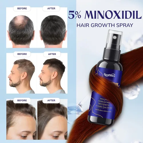 Vista 3 de 5% Minoxidil Hair Growth for Men and Women: Extra Strength Minoxidil Hair Loss Treatment Serum with Rosemary for Faster Stronger Thicker Hair Growth