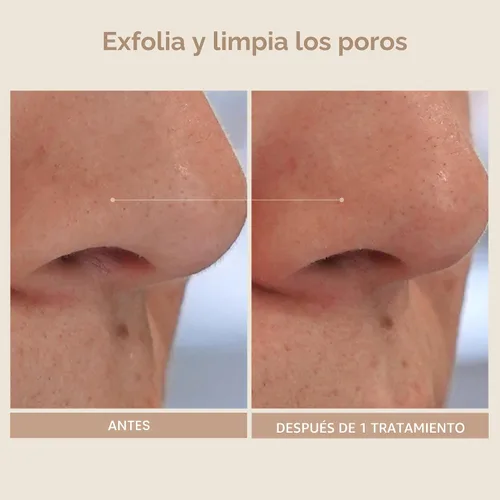 Vista 6 de SHANI DARDEN SKIN CARE Exfoliante Triple Ácido, Exfoliante Facial de 2 Pasos con Ácidos Mandélico, Láctico y Glicólico, Mascarilla Neutralizante