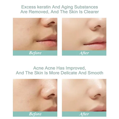 Vista 6 de Aqua Peeling Solution, Salon Professional Premium Dermoabrasión Facial Suero Especial, Cuidado de la Piel Para Máquina Facial Pequeña Burbuja 13.5