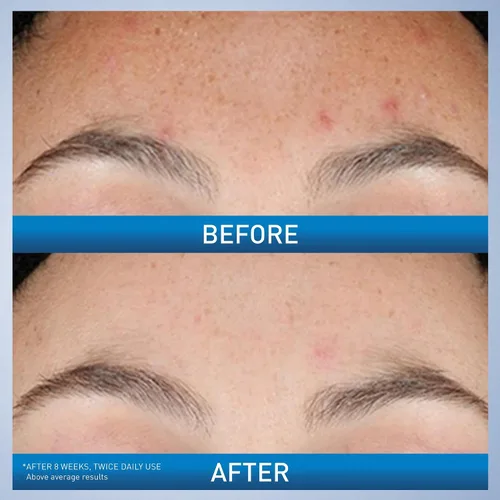 Vista 3 de CeraVe Suero de Retinol Renovador para Marcas Post-Acné, Formulado con Extracto de Raíz de Regaliz y Niacinamida, Suero Iluminador y Minimizador