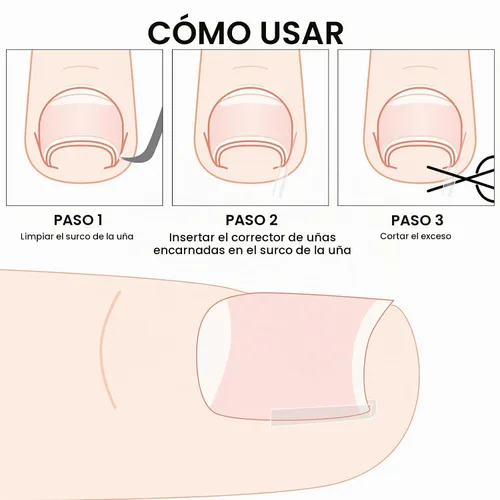 Vista 3 de 60 tiras correctoras de uñas encarnadas, corrección de uñas encarnadas, corrección de uñas, clip para enderezar uñas, parche curvo corrector de uñas