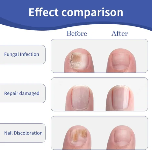 Vista 3 de Tratamiento de hongos en las uñas de los pies, extra fuerte, tratamiento de hongos en las uñas, extra fuerte, solución de reparación de uñas