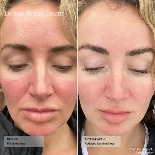 Vista 2 de Senté Dermal Repair Crema facial Nutritiva para rosácea, piel sensible y después del procedimiento Hidrata y suaviza con HSA patentada