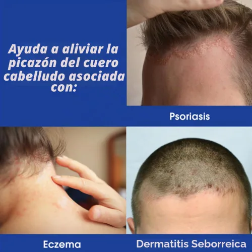 Vista 4 de Tratamiento para la picazón en el cuero cabelludo de máxima fuerza, 1.5 onzas