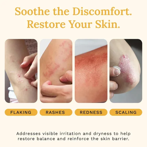 Vista 7 de Rejuvaskin Crema de recuperación de la piel con aloe vera, crema para aliviar el eccema para pieles secas, picazón y sensibles, hidratante