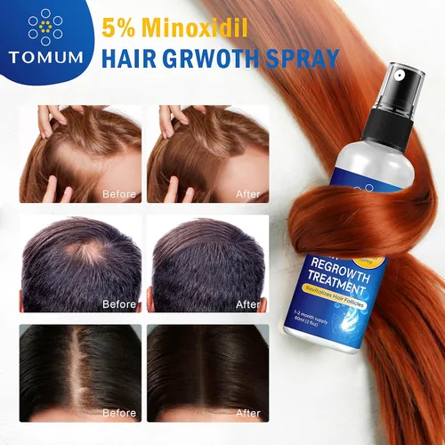Vista 7 de Minoxidil para hombres y mujeres Crecimiento del cabello: 5% de minoxidil en aerosol tópico Tratamiento para el crecimiento del cabello Detener