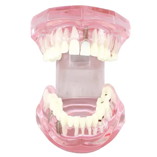 Vista 2 de Demostración oral del puente de la patología del color rosado de los dientes de Typodont de la restauración del implante dental M2001