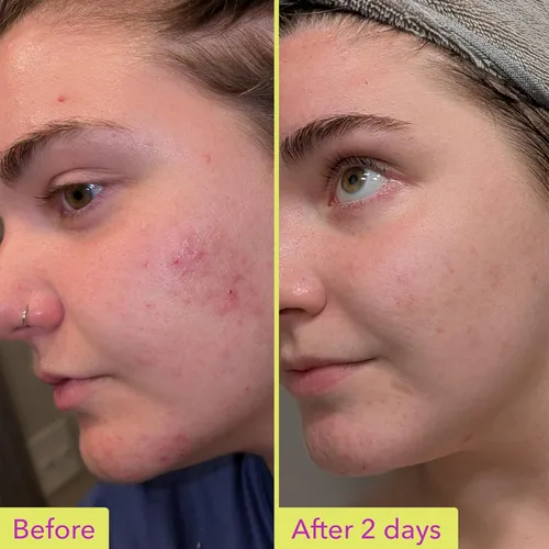 Vista 9 de Good Molecules Tratamiento de 10% de ácido azelaico para la cara – Fórmula calmante para el enrojecimiento facial y el tono desigual – Ilumina