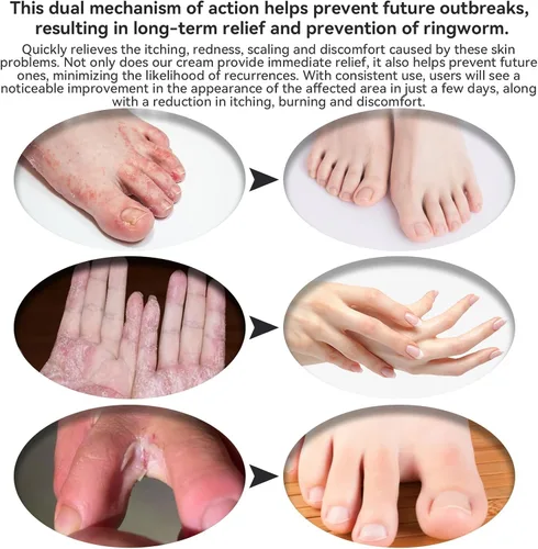 Vista 4 de Crema de erupción por calor, eczema, tratamiento de manos y pies, tiña versicolor, picazón en los pies, trasero, psoriasis, caspa del cuero