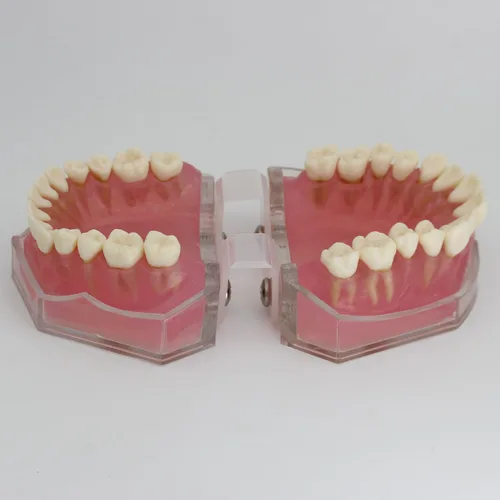 Vista 4 de Modelo de dientes de implante dental con dientes extraíbles para profesionales dentales y estudiantes