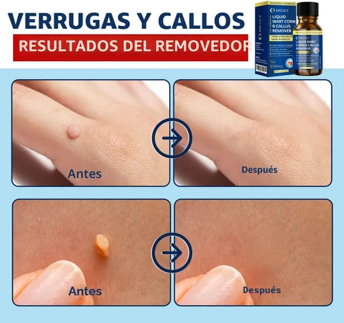 Vista 4 de MEOLY Eliminador de verrugas de acción rápida: removedor de verrugas de ácido salicílico para verrugas plantares, congelación de maíz de acción
