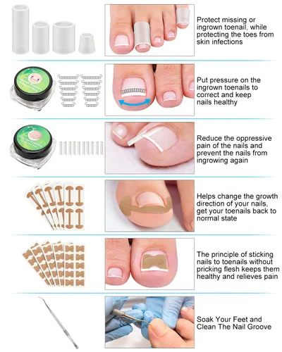 Vista 4 de Kit de eliminación de uñas encarnadas, tratamiento de uñas encarnadas, herramientas correctoras de uñas encarnadas vienen con soportes para uñas