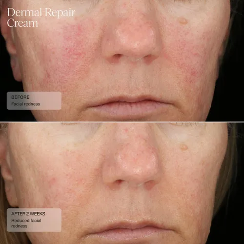 Vista 3 de Senté Dermal Repair Crema facial Nutritiva para rosácea, piel sensible y después del procedimiento Hidrata y suaviza con HSA patentada