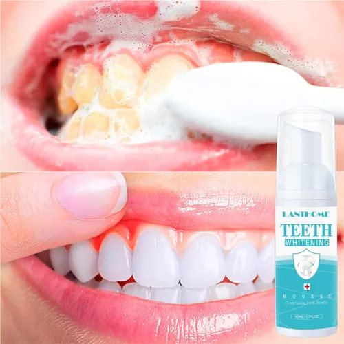 Vista 4 de LANTHOME Productos de blanqueamiento de dientes de espuma blanca (2 piezas) - Mousse blanqueador de dientes, espuma para blanquear los dientes