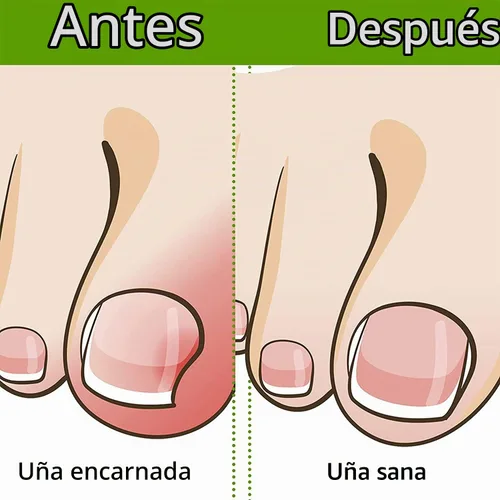 Vista 3 de Tiras correctoras de uñas encarnadas profesionales, 50 tiras correctoras de uñas encarnadas, tiras curvadas para enderezar las uñas del pie, clips