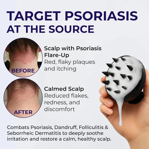 Vista 2 de Champú para Psoriasis Anti Caspa - Champú medicado para el tratamiento de la caspa, escamas, dermatitis seborreica y folikulitis - Solución