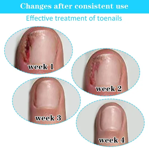 Vista 6 de (50+1) Juego de tratamiento corrector de uñas encarnadas, kit profesional de eliminación de uñas encarnadas sin dolor con levantador de uñas