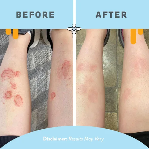 Vista 4 de PSORIASIS HONEY Crema renovadora de la piel, crema para eccema y dermatitis seborreica, tratamiento de psoriasis para aliviar la piel
