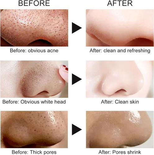 Vista 8 de Mascarilla removedor de puntos negros, mascarilla facial de carbón para limpieza profunda para cara, nariz, poros y acné, para todo