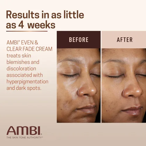 Vista 4 de Ambi Even & Clear Fade Cream, sin hidroquinona, tratamiento de hiperpigmentación, corrector de manchas oscuras, resultados en tan solo 4 semanas