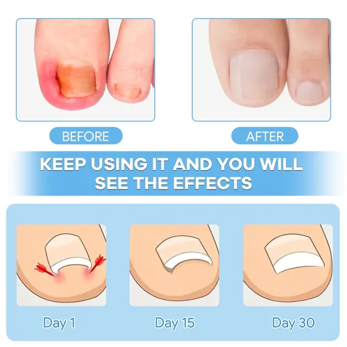 Vista 2 de Kit de eliminación de uñas encarnadas con tiras de uñas encarnadas, parche corrector de uñas curvas, lima de uñas y herramientas de pedicura