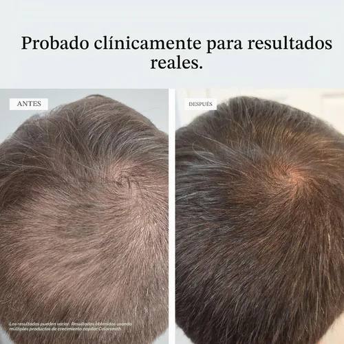 Vista 4 de Gomitas biotina para el cabello, multivitamínico, sabor a cereza, 60 unidades, suministro para 30 días