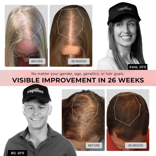 Vista 9 de Capillus Pro S1 - Gorra láser para terapia de luz roja, para el crecimiento