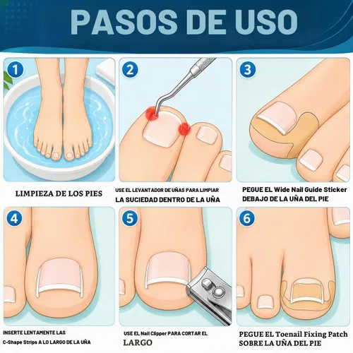 Vista 7 de Juego de corrector de uñas encarnadas con lupa y tiras correctoras, juego de herramientas profesionales de tratamiento de uñas encarnadas, cuidado
