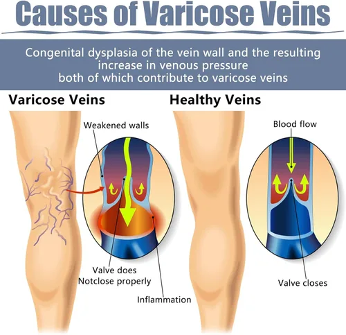 Vista 5 de 36 parches para venas varicosas, tratamiento natural de alivio para piernas, araña, varices, fortalece la salud capilar y mejora la circulación
