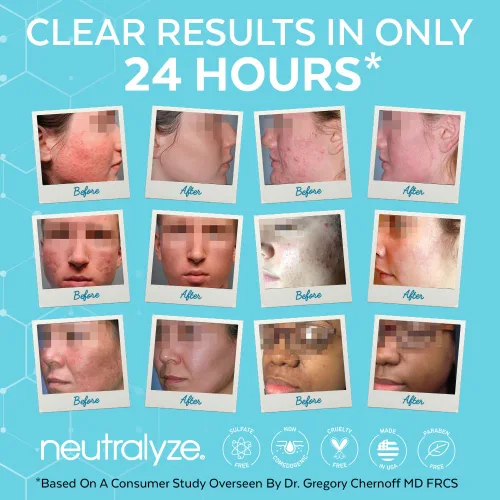 Vista 4 de Neutralyze Jabón facial de ácido mandélico para pieles propensas al acné, limpiador diario de ácido salicílico al 2% con sistema DuoClear, sin