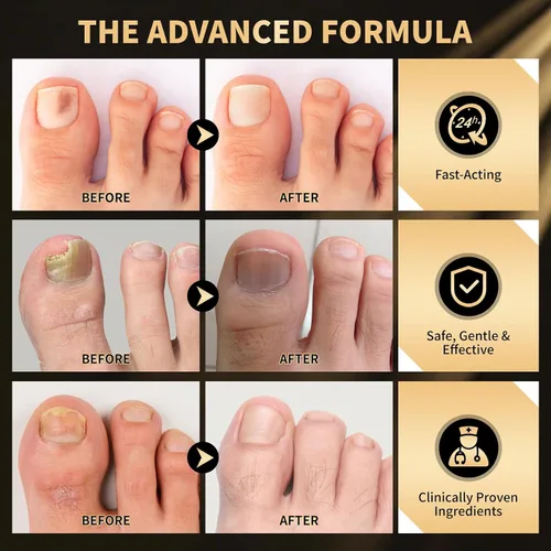 Vista 6 de Bolígrafo extra fuerte para tratamiento de hongos en las uñas de los pies y dedos dañados, extractos de plantas naturales más puros, parches